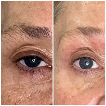 VeliCutis - Elaine Brennan peel before and after - Estheticians Near Me - Scottsdale, Arizona VeliCutis - Elaine Brennan peel before and after - Estheticians Near Me - Scottsdale, Arizona