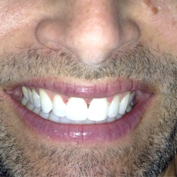 StarrTeeth Dental - My new front teeth - General Dentistry Near Me - Washington, DC, District of Columbia