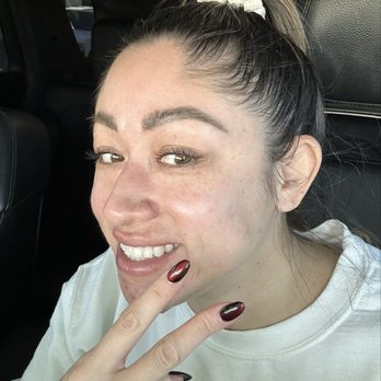 Skin Goddess Spa - Scarring and wrinkles diminished after green sea peel - Skin Care Near Me - Ontario, California Skin Goddess Spa - Scarring and wrinkles diminished after green sea peel - Skin Care Near Me - Ontario, California