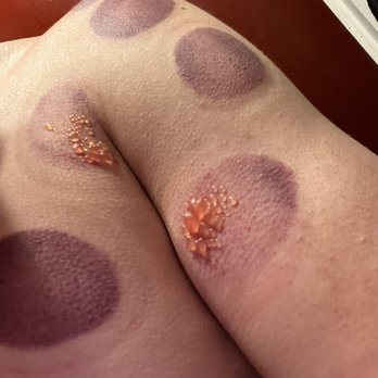 Muscle Lab - More blisters - Cryotherapy Near Me - Pasadena, California Muscle Lab - More blisters - Cryotherapy Near Me - Pasadena, California