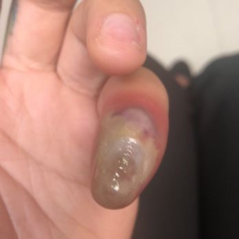 Evan Nails - Infected Fingernail - Nail Salons Near Me - Houston, Texas Evan Nails - Infected Fingernail - Nail Salons Near Me - Houston, Texas