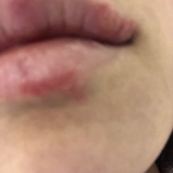 Aesthetic Kay - Got worse on the second day - Skin Care Near Me - San Francisco, California