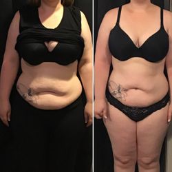 The Lipo Lounge - So proud of our patients!
