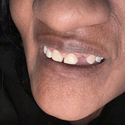 Bright Now Dental & Orthodontics - My  teeth for the coast 3 weeks
