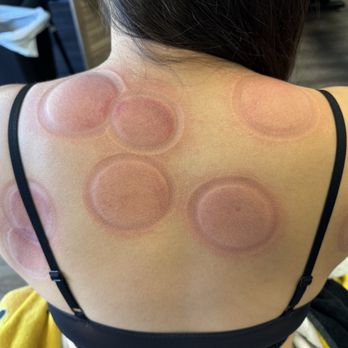 ChiroFit Rehab - Dry cupping = immediate pain relief - Chiropractors Near Me - Daly City, California ChiroFit Rehab - Dry cupping = immediate pain relief - Chiropractors Near Me - Daly City, California