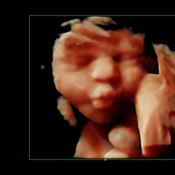SonoSmile - 3D/4D HDlive ultrasound image showing a baby blowing kisses and making a sweet face. - Diagnostic Imaging Near Me - Ocala, Florida