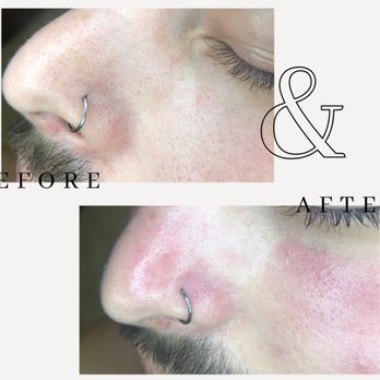Eternal Esthetics - Before and after results from deep pore cleansing facial. - Skin Care Near Me - Orlando, Florida