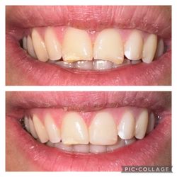 San Ramon Dentist - Bollinger Canyon Dental