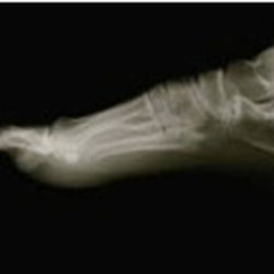 Comprehensive Foot and Ankle Center PA