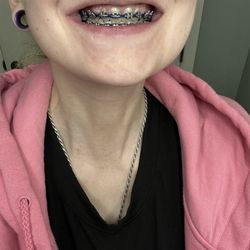 Welmerink & Utter Orthodontics - Braces after final adjustment
