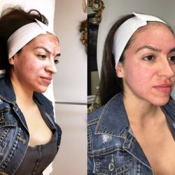 Blanca Stafford Brows and Skin - DARK SPOTS REMOVAL with Microneedling PRP
