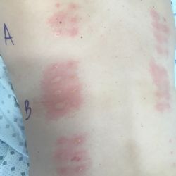 University of Utah Allergy & Immunology Clinic