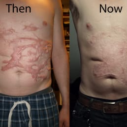 This is a comparison photo to show the difference in how I healed after my 2nd and 3rd degree burns, and how I look today.