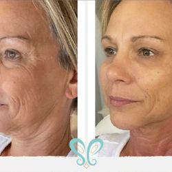 Skin Esteem - Radiesse® Face and Neck