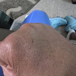 Community Radiology Associates Inc - The technician attempted 3 times to start a line in both arms & hand for an MRI with contrast and was unsuccessful.