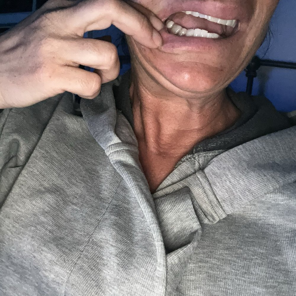 My bite. Uneven. Teeth slant