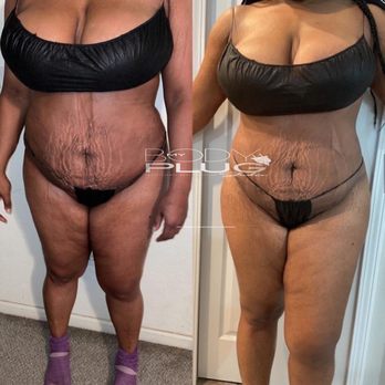 My Body Plug Studio - MY BODY PLUG STUDIO BEFORE & AFTER - Body Contouring Near Me - Southfield, Michigan My Body Plug Studio - MY BODY PLUG STUDIO BEFORE & AFTER - Body Contouring Near Me - Southfield, Michigan