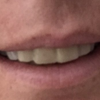 Brian Dental Care - These are the awful golden teeth I had to wear while getting my veneers done. - General Dentistry Near Me - Tustin, California Brian Dental Care - These are the awful golden teeth I had to wear while getting my veneers done. - General Dentistry Near Me - Tustin, California