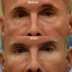 Daniel Straka , MD - Before and after Botox for a lateral brow lift and filler injections to the cheeks and under eye area for lower eyelid bags and flat cheeks.