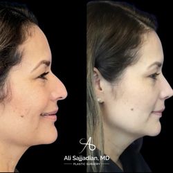 Ali Sajjadian, MD - Before and After | Surgical Rhinoplasty
