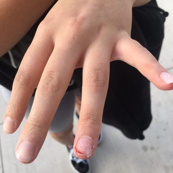 Bella Nails & Spa - The ring fingernail the lady inured. - Nail Salons Near Me - Oxnard, California