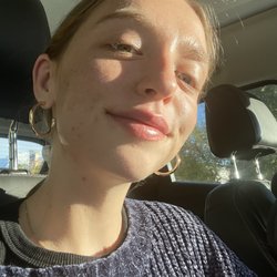 Salt Lake City Botox and Fillers - After