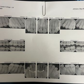 American Career College - X-rays we got to work on as part of the hands on experience. - Colleges & Universities Near Me - Ontario, California American Career College - X-rays we got to work on as part of the hands on experience. - Colleges & Universities Near Me - Ontario, California