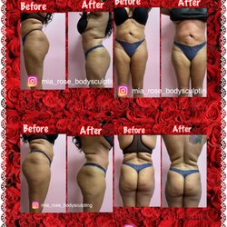 Mía Rose Body Sculpting - Detox Sunday's Special + Ultrasound Cavitation +Radio Frequency + Lymphatic Massage + Wood Therapy and lastly Yesoterapia for the win!