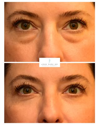 Eyes / Browlift - View the results of real patients who have had a brow lift and eyelid surgery by Dr. John Park (individual results may vary).