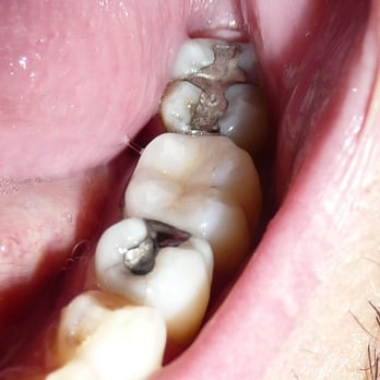 Ron Barry, DMD - It's the pretty one between the Fillings. - General Dentistry Near Me - Del Mar, California Ron Barry, DMD - It's the pretty one between the Fillings. - General Dentistry Near Me - Del Mar, California