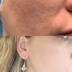 Lumi Med Aesthetics - Before and after - charcoal peel! Get one NOW - my skin was completely resurfaced!!
