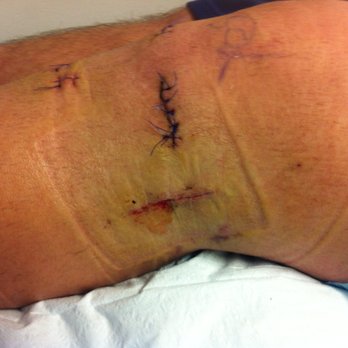 Arthur J Ting, MD - Picture of Timmy's full meniscus replacement. - Orthopedists Near Me - Fremont, California
