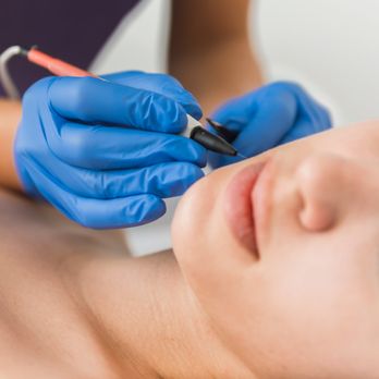 Moon Electrolysis - Hair Removal Near Me - New York, New York Moon Electrolysis - Hair Removal Near Me - New York, New York