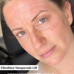 WrightLooks - Fibroblast Skin Tightening