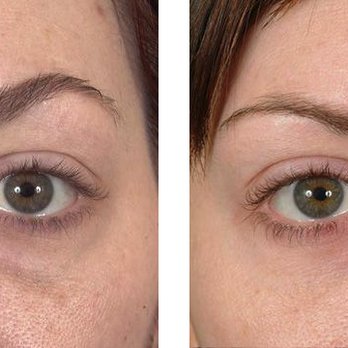 Lee Facial Plastic Surgery - Before and After from Lee Facial Plastic Surgery | Boston, MA - Plastic Surgeons Near Me - Boston, Massachusetts Lee Facial Plastic Surgery - Before and After from Lee Facial Plastic Surgery | Boston, MA - Plastic Surgeons Near Me - Boston, Massachusetts
