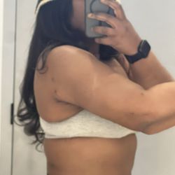 Bella Cosmetic Surgery - Arm lift