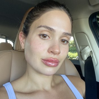 Hochstein Medspa - After filler and Botox - Medical Spas Near Me - Miami, Florida
