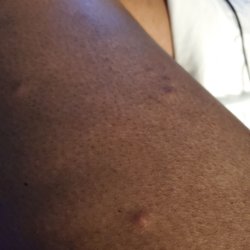 Holiday Inn Express & Suites Summerville - bedbug bites