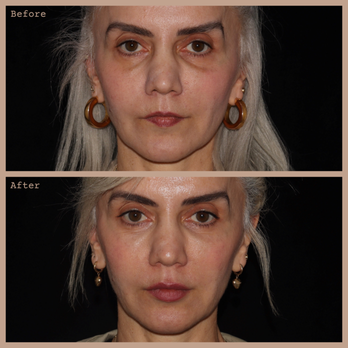 ROUTINE by Anush Movsesian - Lip Augmentation and Under Eyes with Hyaluronic Acid Filler - Medical Spas Near Me - Studio City, California ROUTINE by Anush Movsesian - Lip Augmentation and Under Eyes with Hyaluronic Acid Filler - Medical Spas Near Me - Studio City, California