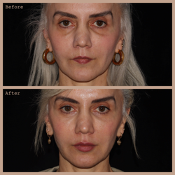 ROUTINE by Anush Movsesian - Lip Augmentation and Under Eyes with Hyaluronic Acid Filler