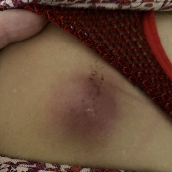 Clovis Urgent Care - Infected cyst - Urgent Care Near Me - Clovis, California