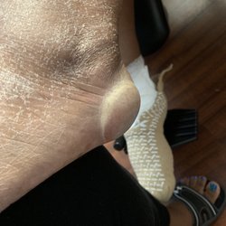 Pruitt Health Care of Augusta Hills - Stage 2 pressure ulcer to heel