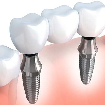 Endodontic Center - Implant-Supported Bridges - General Dentistry Near Me - Stoughton, Massachusetts Endodontic Center - Implant-Supported Bridges - General Dentistry Near Me - Stoughton, Massachusetts