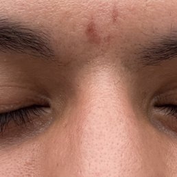 Burns from eyebrow waxing Burns from eyebrow waxing