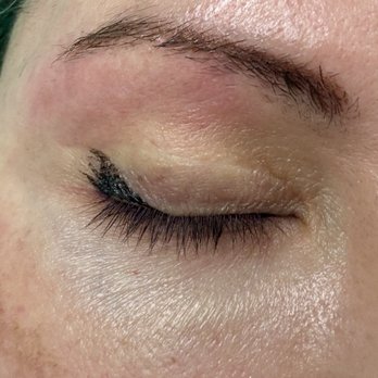 Nicole's Electrolysis - Immediately after treatment, the redness only lasts a few minutes. - Hair Removal Near Me - Sacramento, California