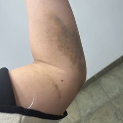 Kelsey-Seybold Clinic - River Oaks Clinic - Arm injury