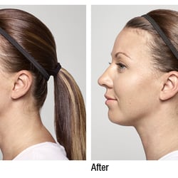 Baltimore Bodies MedSpa - Restylane Silk. Before and After