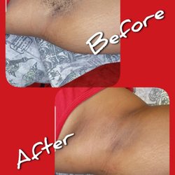Before and after underarm hard wax hair removal