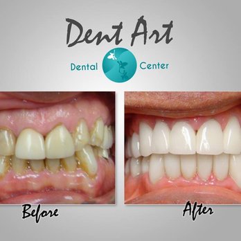 Dent Art - Porcelain Crowns/Veneers Before and After  Dent Art Center - Cosmetic Dentists Near Me - Tijuana, BCN