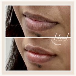 Ideal Esthetics - Lip filler immediately before & after